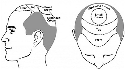 SELECT THE AREAS OF YOUR SCALP WHERE YOU NEED HAIR RESTORATION